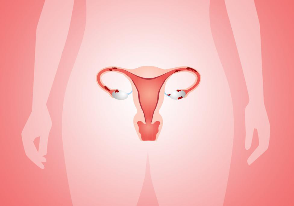Woman’s uterus inflicted with a painful condition called endometriosis